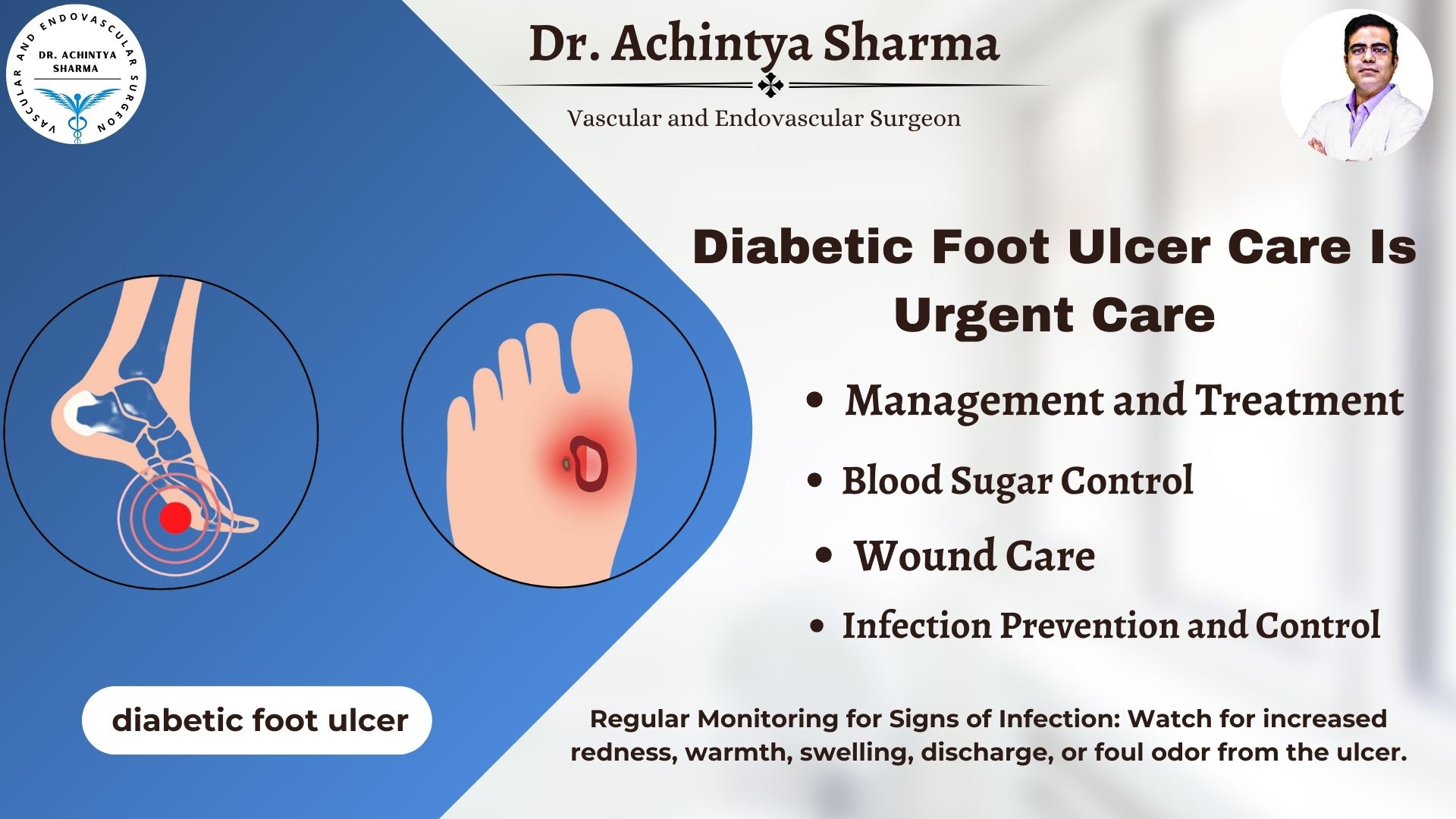 Read more about the article Early Stage Diabetic Foot Ulcer: Signs, Care, and Prevention