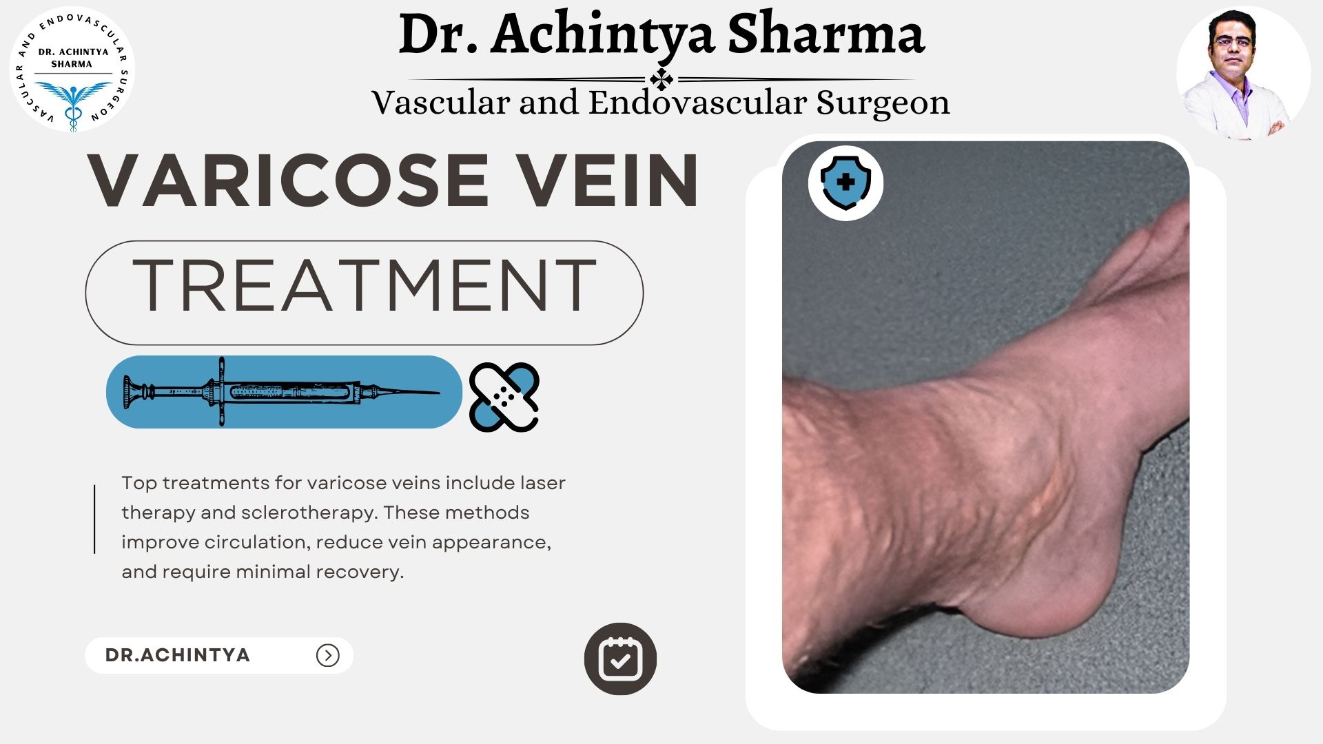 Read more about the article Discover the Best Treatment for Varicose Veins for Lasting Relief
