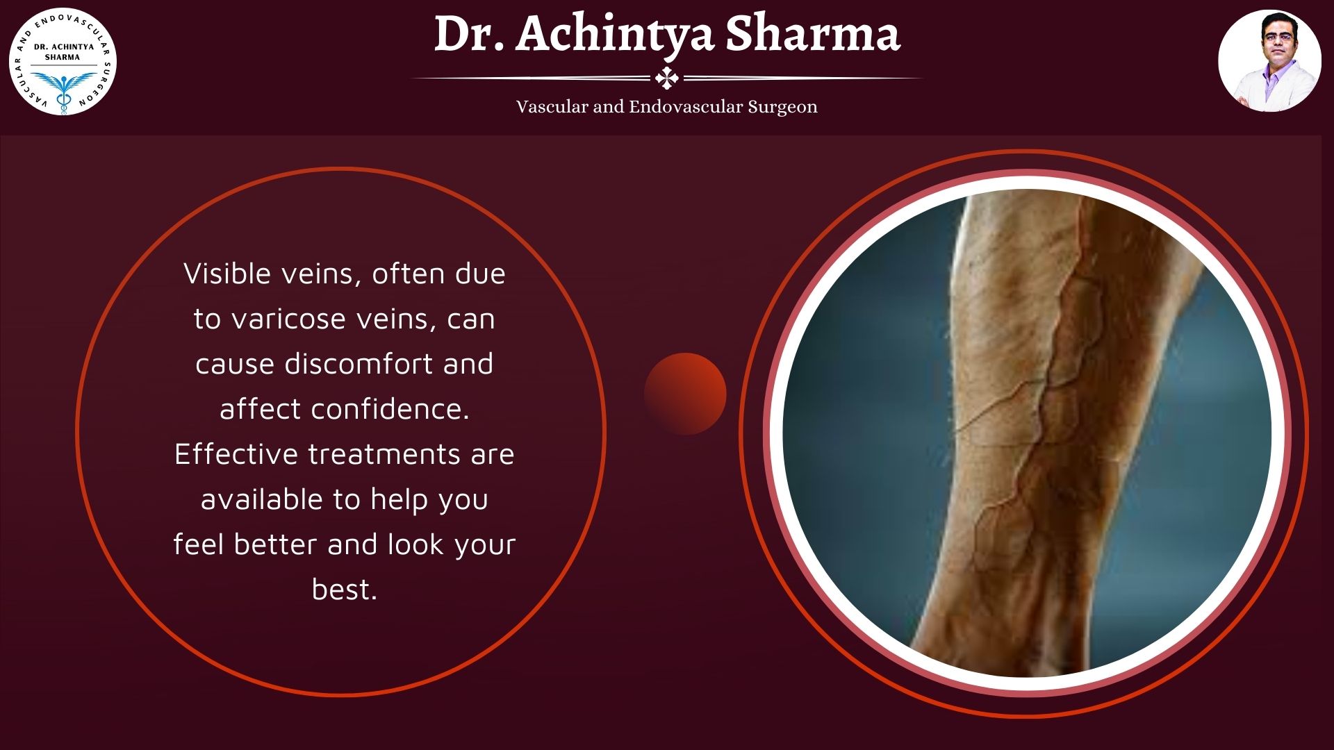 Read more about the article Visible Veins on Legs Explained: Symptoms, Causes, and Fixes